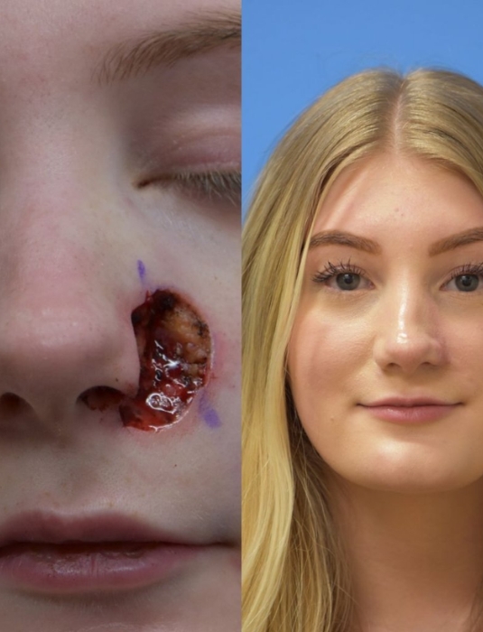 Reconstructive Surgeries